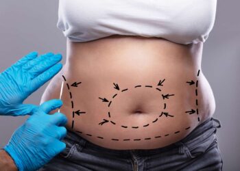 Top Resources for Tummy Tuck Patients: Finding the Best Doctors in Dubai
